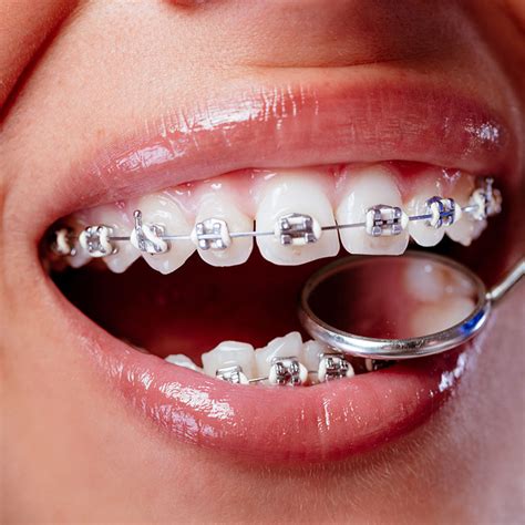 bracket metalicos|brackets dentista.